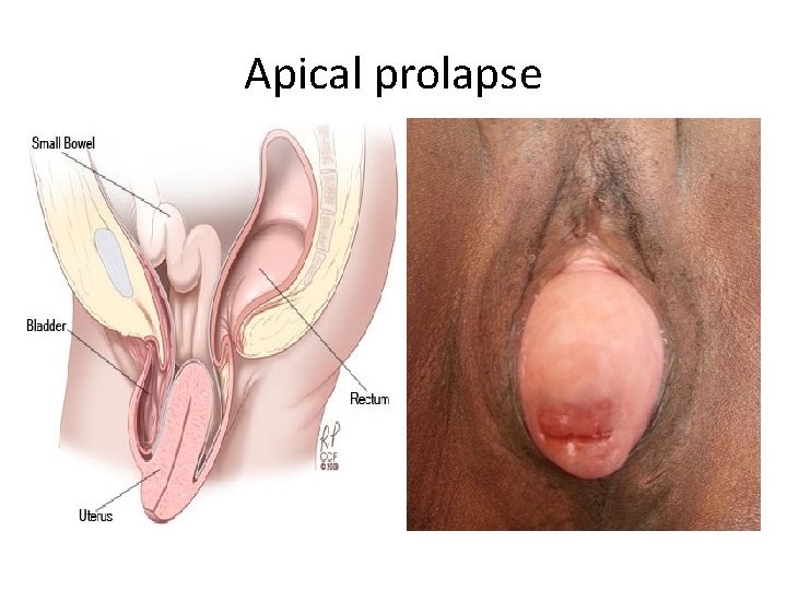 Apical prolapse 