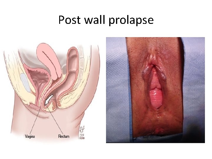Post wall prolapse 