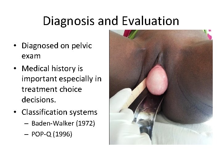 Diagnosis and Evaluation • Diagnosed on pelvic exam • Medical history is important especially