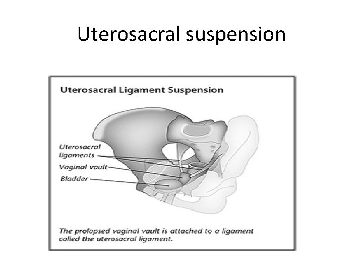 Uterosacral suspension 