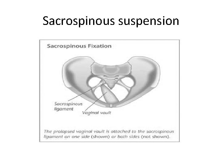 Sacrospinous suspension 