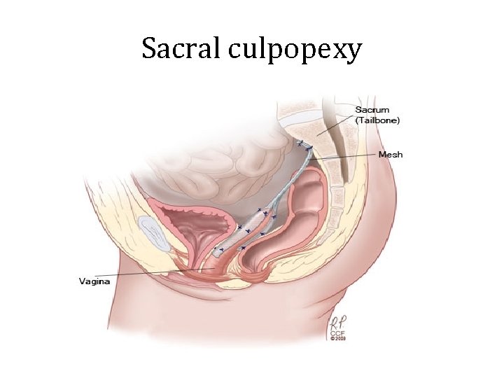 Sacral culpopexy 