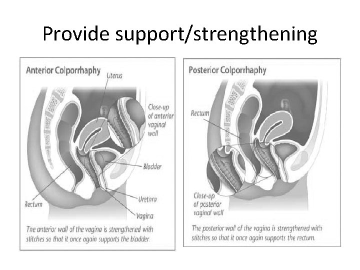 Provide support/strengthening 