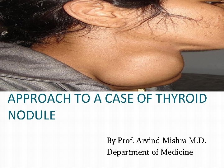 APPROACH TO A CASE OF THYROID NODULE By Prof. Arvind Mishra M. D. Department