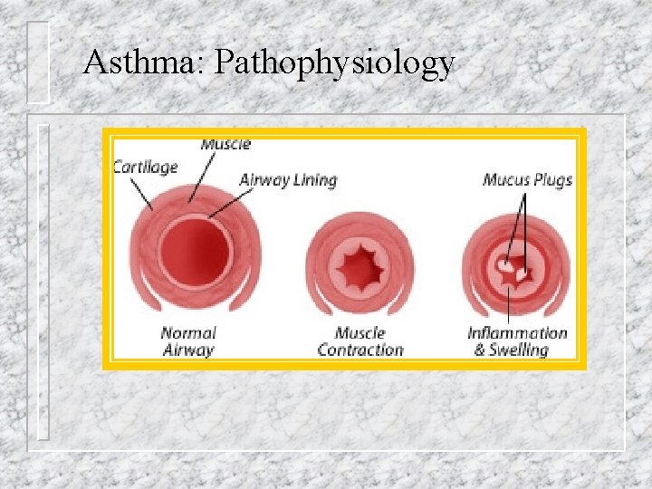 Asthma: Pathophysiology 