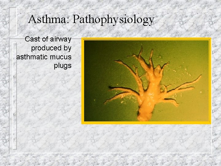 Asthma: Pathophysiology Cast of airway produced by asthmatic mucus plugs 