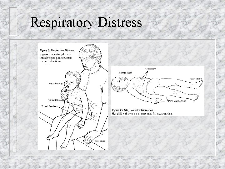 Respiratory Distress 