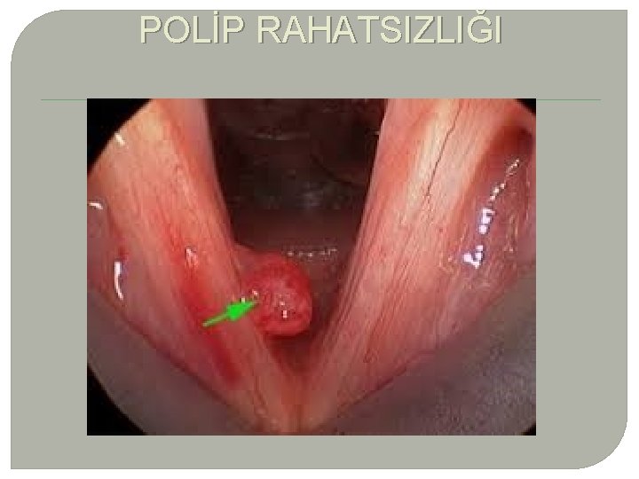 POLİP RAHATSIZLIĞI 