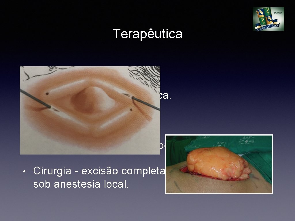 Terapêutica • Indicação - “dor” ou estética. • Não há urgência. • Não necessita