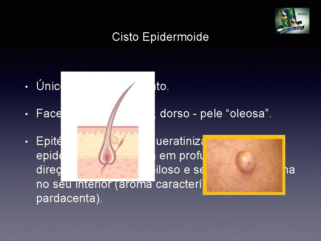 Cisto Epidermoide • Único, crescimento lento. • Face, pescoço, tronco, dorso - pele “oleosa”.