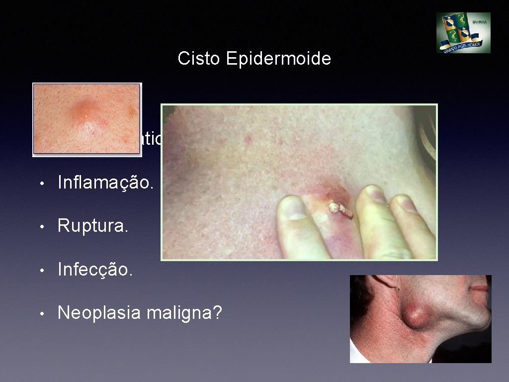 Cisto Epidermoide • Assintomático. • Inflamação. • Ruptura. • Infecção. • Neoplasia maligna? 