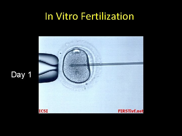 In Vitro Fertilization Day 1 