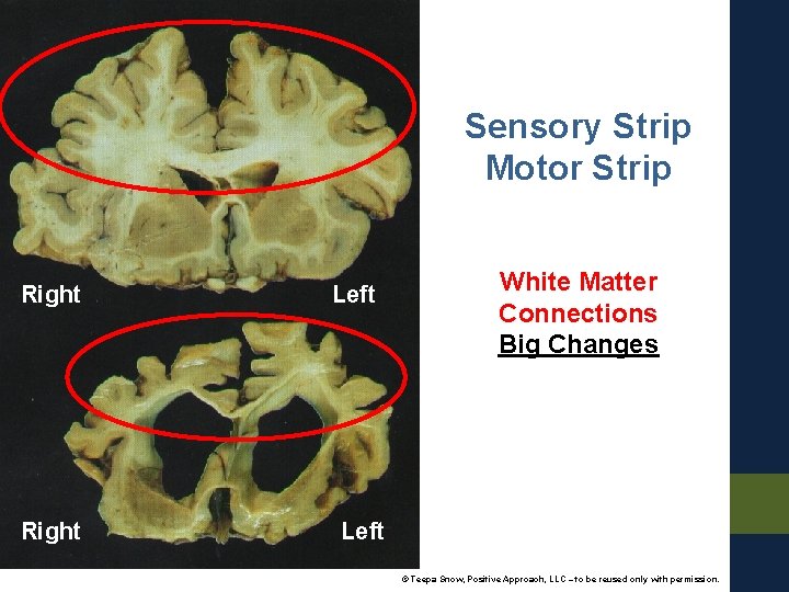 Sensory Strip Motor Strip Right Left White Matter Connections Big Changes Left © Teepa
