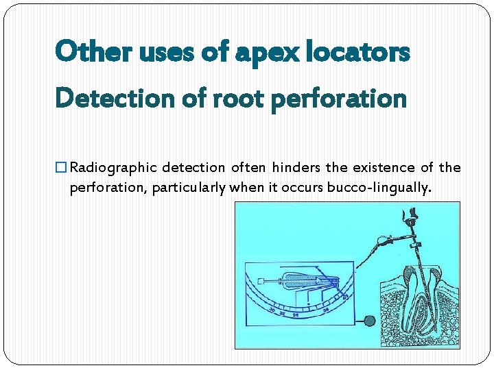 Other uses of apex locators Detection of root perforation � Radiographic detection often hinders