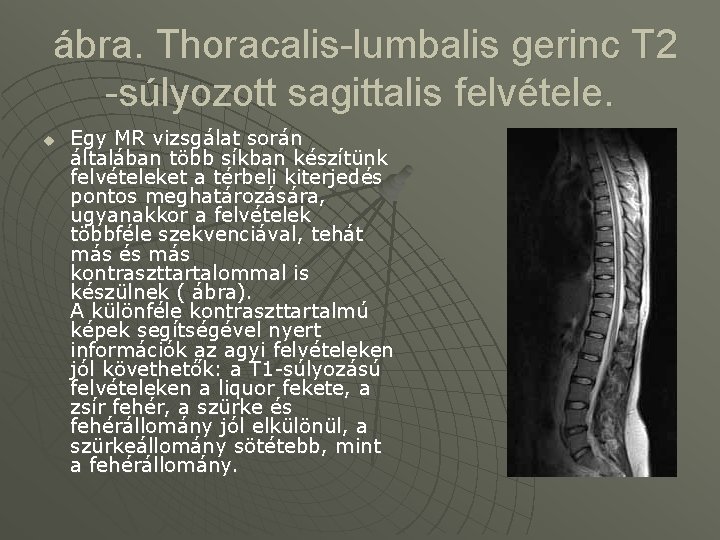  ábra. Thoracalis-lumbalis gerinc T 2 -súlyozott sagittalis felvétele. u Egy MR vizsgálat során