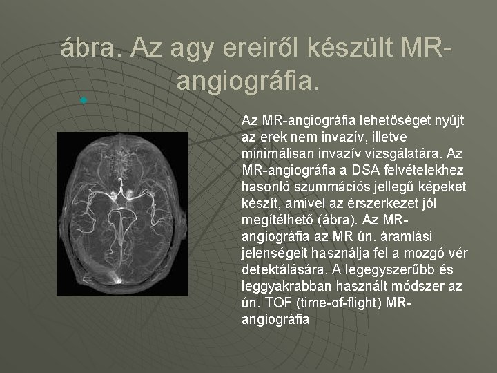  ábra. Az agy ereiről készült MRangiográfia. u Az MR-angiográfia lehetőséget nyújt az erek