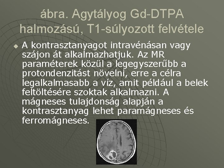 ábra. Agytályog Gd-DTPA halmozású, T 1 -súlyozott felvétele u A kontrasztanyagot intravénásan vagy szájon