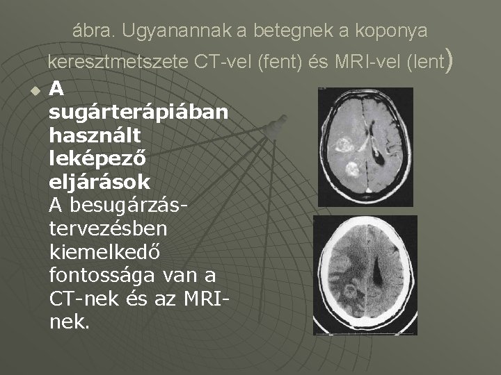 ábra. Ugyanannak a betegnek a koponya keresztmetszete CT-vel (fent) és MRI-vel (lent) u A