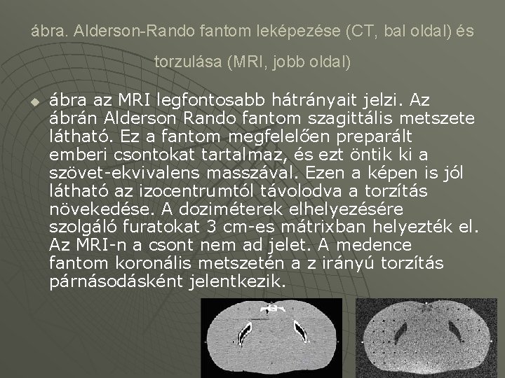 ábra. Alderson-Rando fantom leképezése (CT, bal oldal) és torzulása (MRI, jobb oldal) u ábra