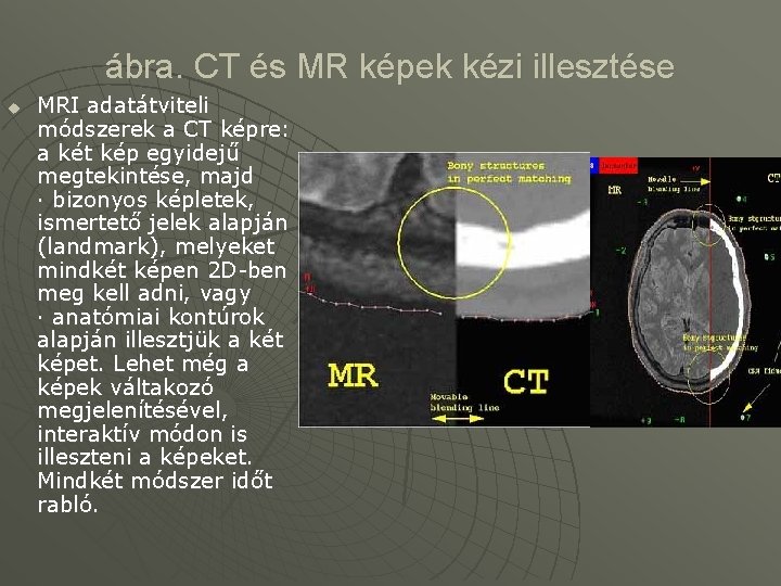 ábra. CT és MR képek kézi illesztése u MRI adatátviteli módszerek a CT képre: