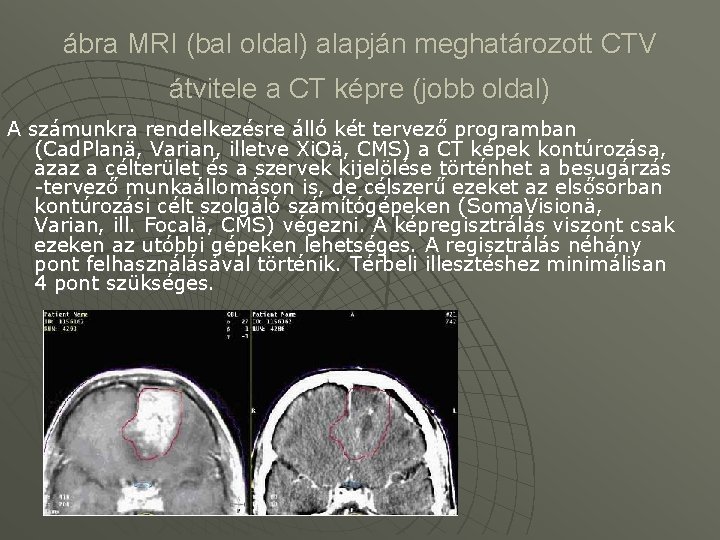 ábra MRI (bal oldal) alapján meghatározott CTV átvitele a CT képre (jobb oldal) A