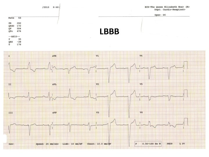 LBBB LBBB