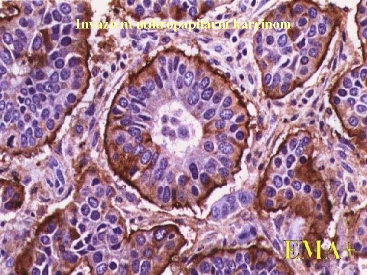 Invazivní mikropapilární karcinom 