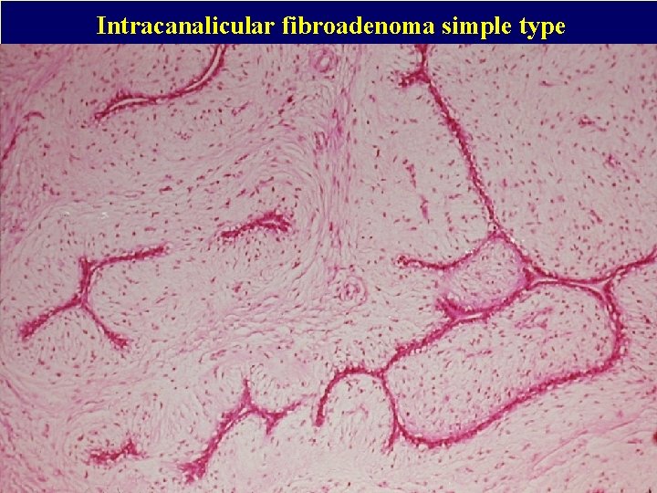 Intracanalicular fibroadenoma simple type 