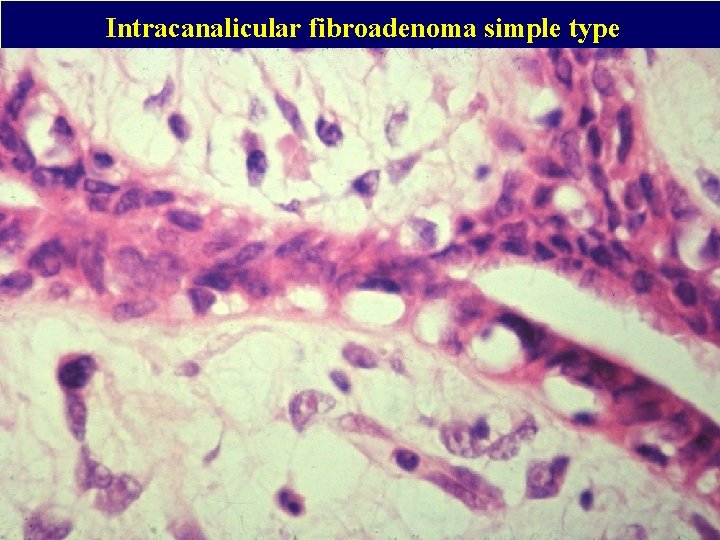 Intracanalicular fibroadenoma simple type 