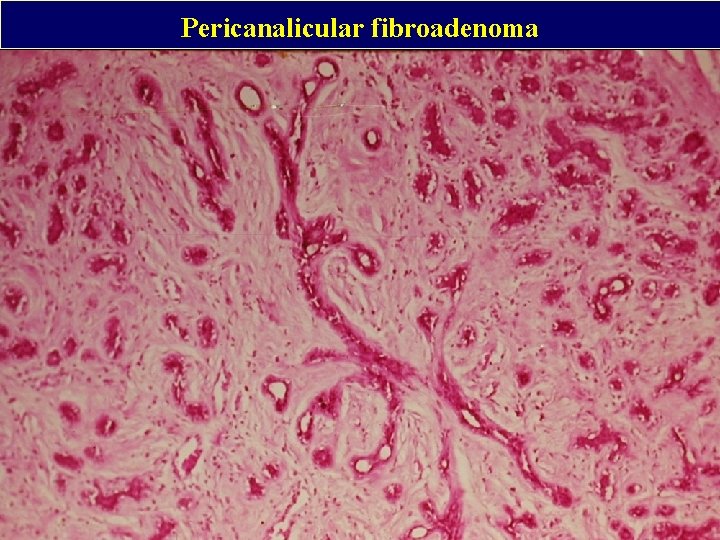 Pericanalicular fibroadenoma 