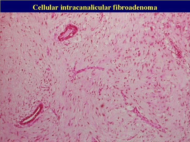 Cellular intracanalicular fibroadenoma 