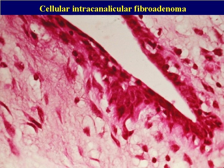 Cellular intracanalicular fibroadenoma 