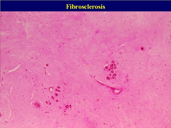 Fibrosclerosis 