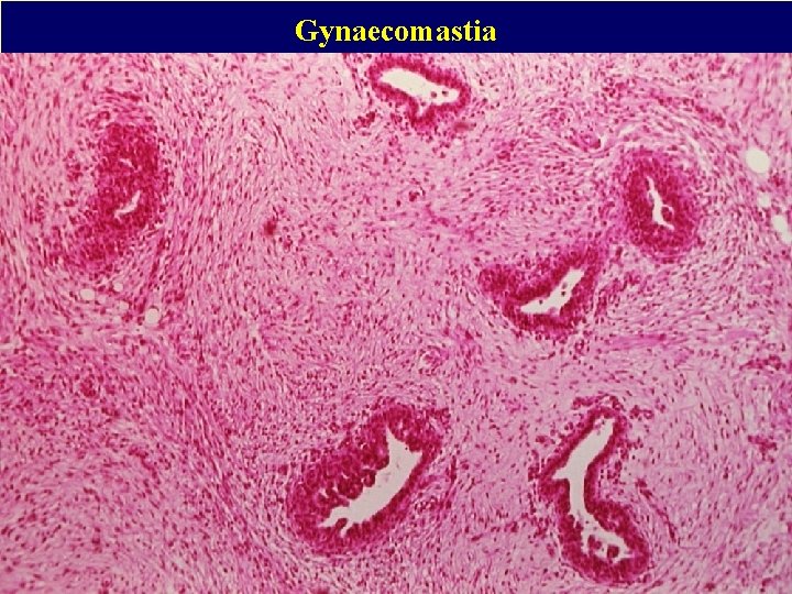 Gynaecomastia 