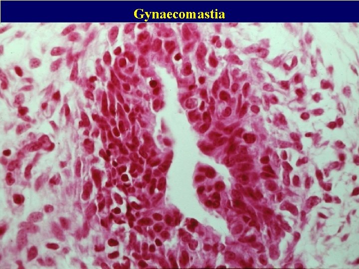 Gynaecomastia 