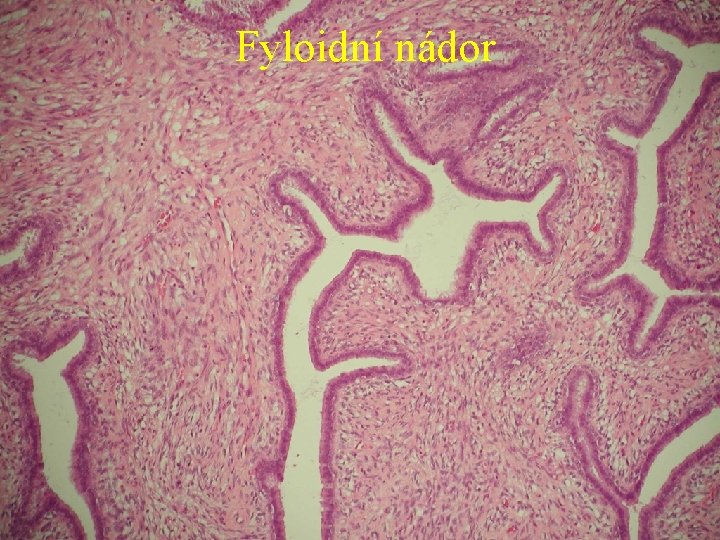 Fyloidní nádor 
