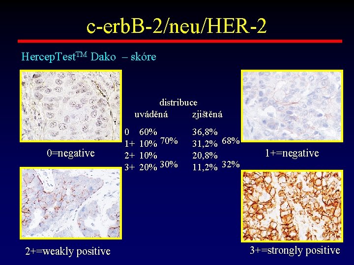 c-erb. B-2/neu/HER-2 Hercep. Test. TM Dako – skóre distribuce uváděná zjištěná 0=negative 2+=weakly positive