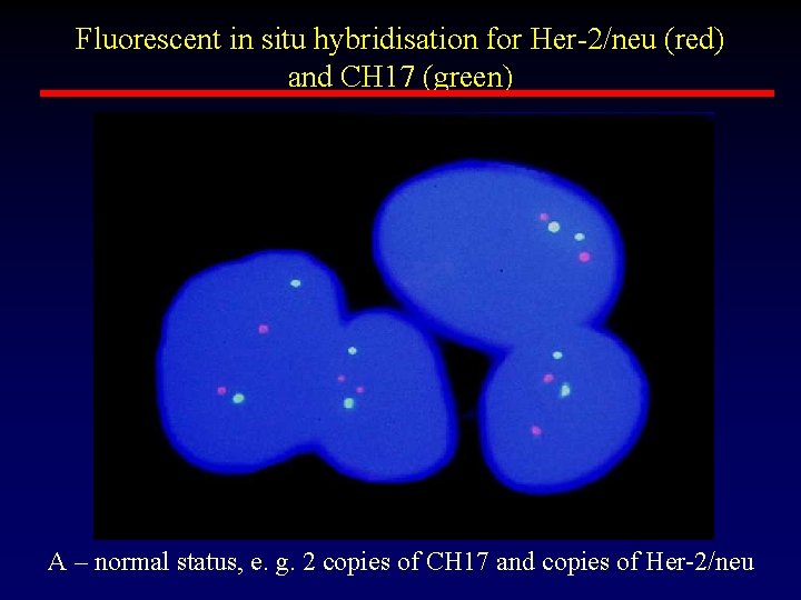 Fluorescent in situ hybridisation for Her-2/neu (red) and CH 17 (green) A – normal