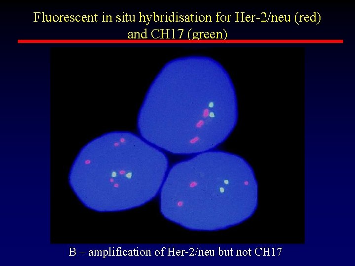 Fluorescent in situ hybridisation for Her-2/neu (red) and CH 17 (green) B – amplification