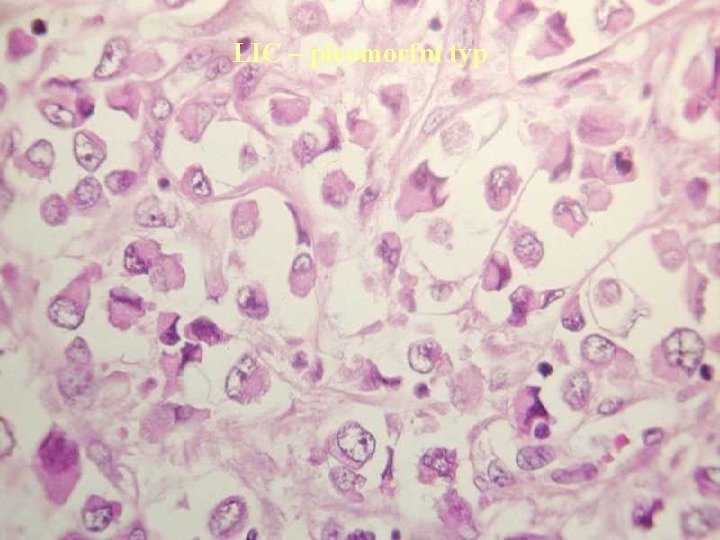 LIC – pleomorfní typ 