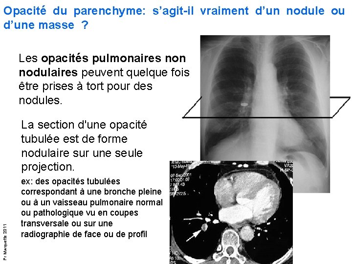 Limagerie thoracique pour lECN Leon 6 tumeurs pulmonaires
