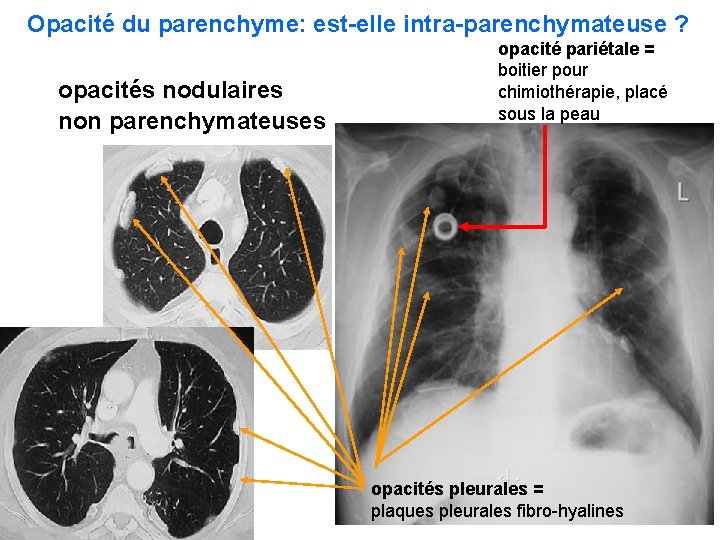 Limagerie thoracique pour lECN Leon 6 tumeurs pulmonaires