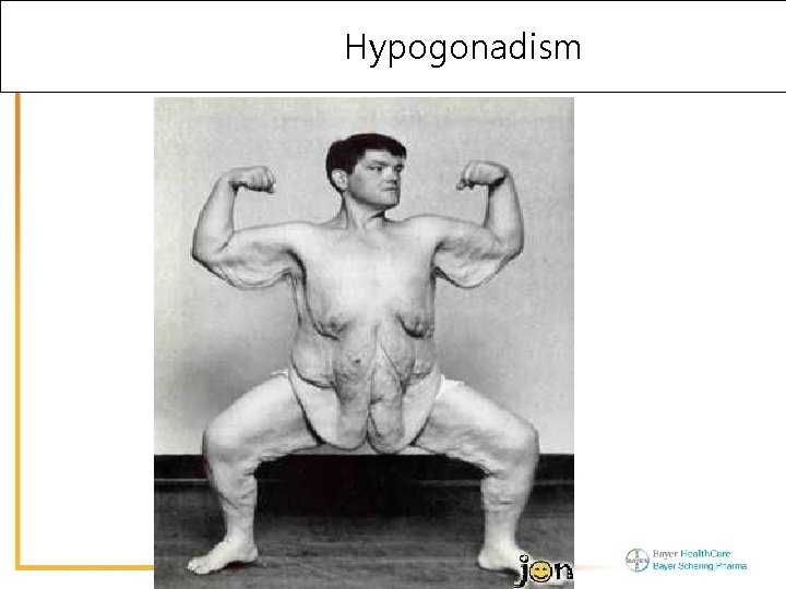 Hypogonadism 