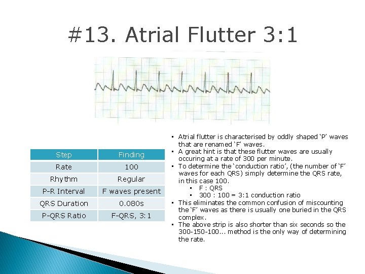 #13. Atrial Flutter 3: 1 Step Finding Rate 100 Rhythm Regular P-R Interval F #13. Atrial Flutter 3: 1 Step Finding Rate 100 Rhythm Regular P-R Interval F
