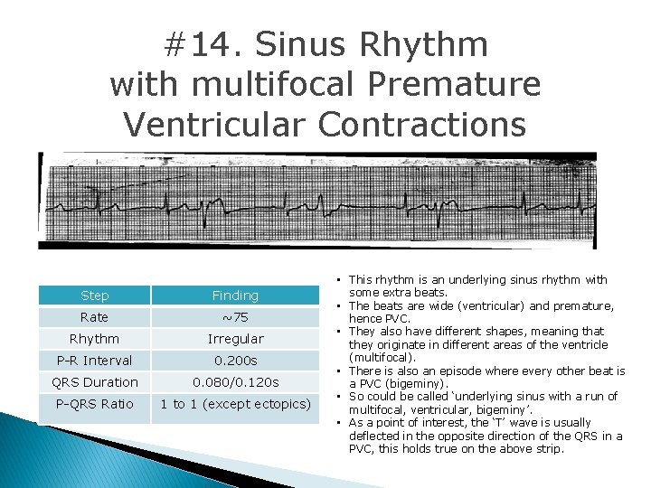 #14. Sinus Rhythm with multifocal Premature Ventricular Contractions Step Finding Rate ~75 Rhythm Irregular #14. Sinus Rhythm with multifocal Premature Ventricular Contractions Step Finding Rate ~75 Rhythm Irregular