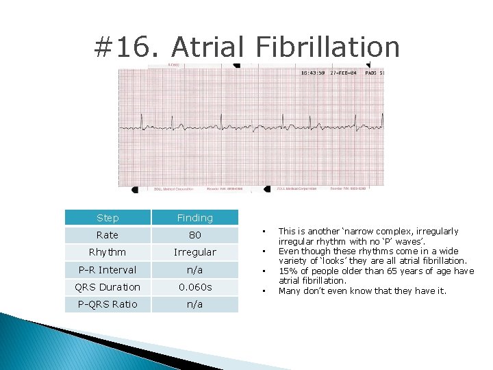 #16. Atrial Fibrillation Step Finding Rate 80 • Rhythm Irregular • P-R Interval n/a #16. Atrial Fibrillation Step Finding Rate 80 • Rhythm Irregular • P-R Interval n/a