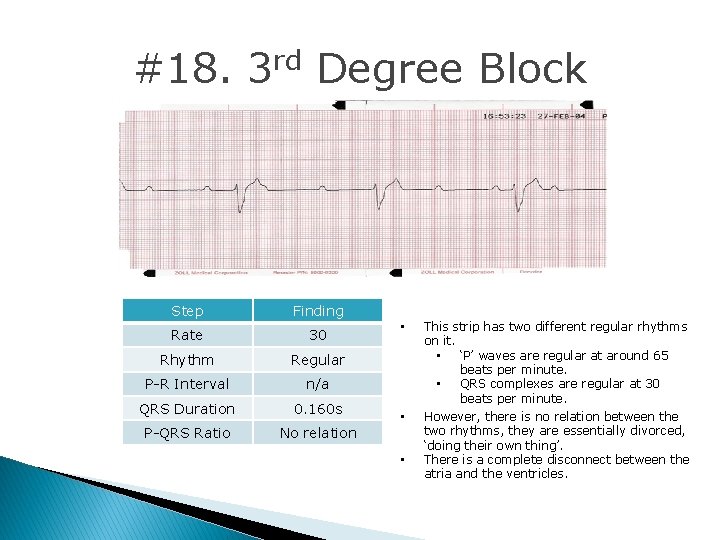 #18. 3 rd Degree Block Step Finding Rate 30 Rhythm Regular P-R Interval n/a #18. 3 rd Degree Block Step Finding Rate 30 Rhythm Regular P-R Interval n/a