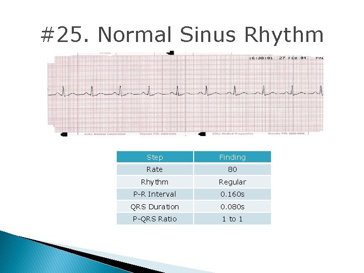 #25. Normal Sinus Rhythm Step Finding Rate 80 Rhythm Regular P-R Interval 0. 160 #25. Normal Sinus Rhythm Step Finding Rate 80 Rhythm Regular P-R Interval 0. 160