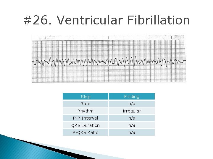#26. Ventricular Fibrillation Step Finding Rate n/a Rhythm Irregular P-R Interval n/a QRS Duration #26. Ventricular Fibrillation Step Finding Rate n/a Rhythm Irregular P-R Interval n/a QRS Duration