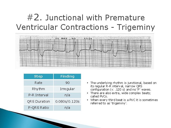 #2. Junctional with Premature Ventricular Contractions - Trigeminy Step Finding Rate 90 Rhythm Irregular #2. Junctional with Premature Ventricular Contractions - Trigeminy Step Finding Rate 90 Rhythm Irregular